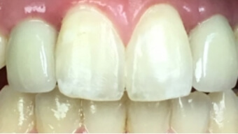 Closeup of smile with two missing teeth after dental implant restoration