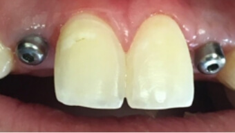 Closeup of smile with two missing teeth after dental implant post placement