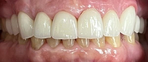 Fully repaired smile after dental restoration