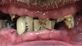 Closeup of smile with severe tooth decay