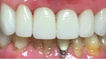 Closeup of smile after dental restoration is placed