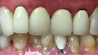 Closeup of damaged smile before dental treatment