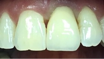 Closeup of smile after missing tooth is replaced with a dental implant