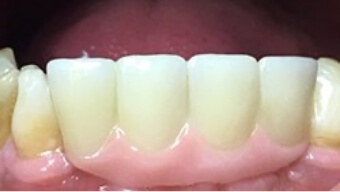 Closeup of smile after dental implant tooth replacement
