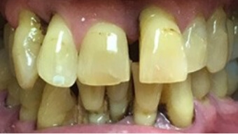 Severely yellowed and damaged smile