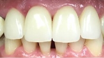 Healthy smile with repaired chip and removed tooth decay