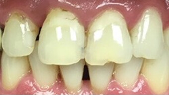Chipped front teeth with decay around the gums