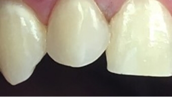 Closeup of top tooth after natural looking dental restoration