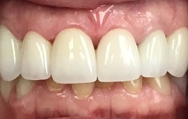 Closeup of smile after top teeth are repaired