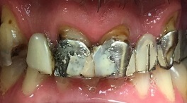 Closeup of extensive tooth decay on top teeth