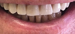 Closeup of flawless smile with natural looking dental restoration