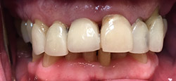 Closeup of smile with unnatural looking dental restoration