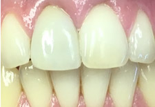 Closeup of smile with whitened top front tooth