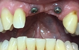 Missing top teeth with dental implant posts visible