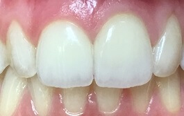 Closeup of smile with repaired teeth and gums