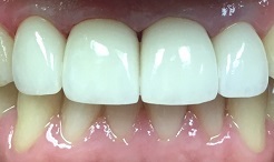Bright smile after teeth whitening