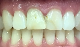 Decayed and damaged top two front teeth