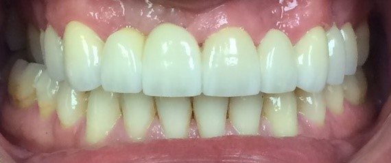 Repaired and replaced teeth after dental restoration