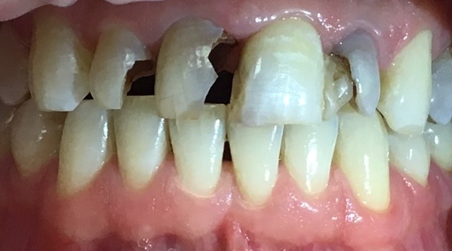 Severe tooth decay and broken teeth