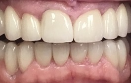 Closeup of flawless smile after full mouth dental restoration