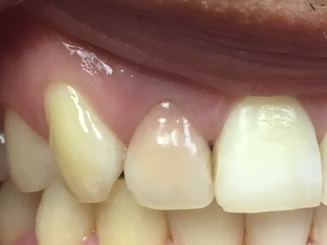 Closeup of damaged smile with gum tissue recession