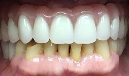 Closeup of flawless smile after cosmetic dentistry