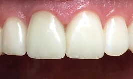 Whitened top two front teeth