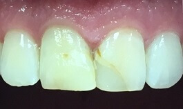 Discolored top two front teeth