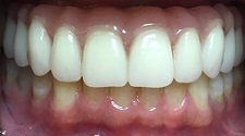 Bright healthy smile with decay repaired