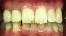 Yellowed teeth with decay and damage