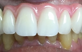Smile after dental implant restoration