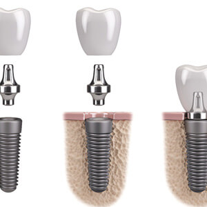 illustration of the parts of a dental implant