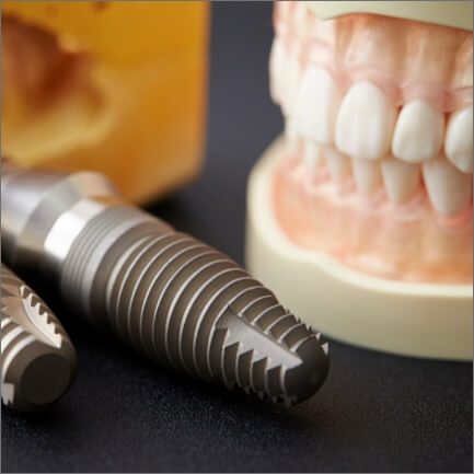 Model of implant denture with mini dental implant posts