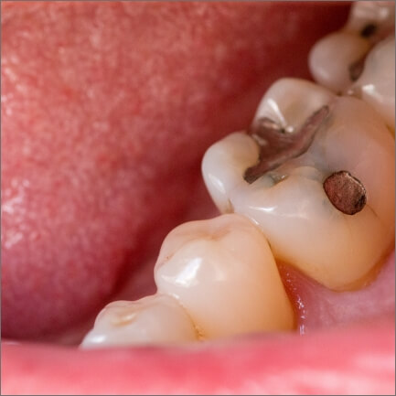 Closeup of smile with tooth fracture from silver mercury fillings