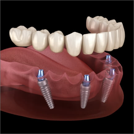Animated smile during dental implant supported denture