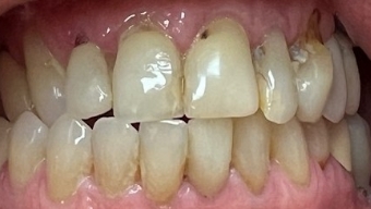 Closeup of smile with missing bottom teeth