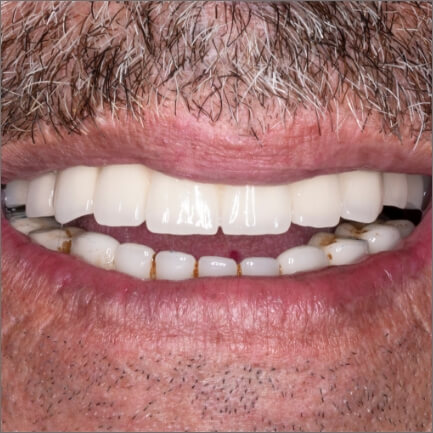 Closeup of smile with dental implants