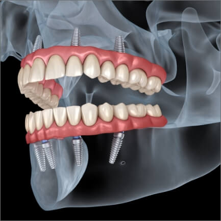 Animated smile demonstrating the all on four dental implants process