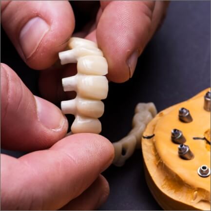 Dental lab technician crafting a dental implant supported denture