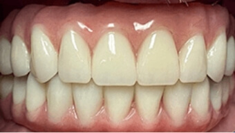 Closeup of healthy smile after dental restoration
