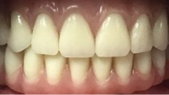 Bright white healthy smile after dental restoration and cosmetic dentistry