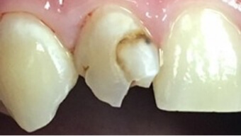 Broken and decayed top tooth