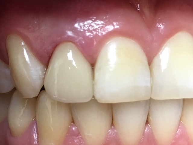 Closeup of healthy smile after gum tissue restoration