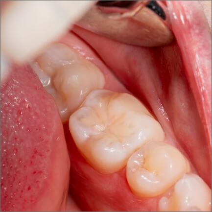 Closeup of smile after dental sealant placement
