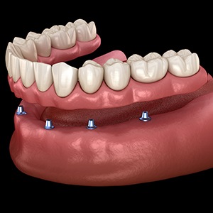 Model of implant-supported denture
