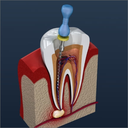 Animated smile during root canal treatment