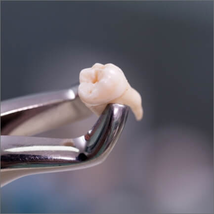 Metal clasp holding extracted tooth