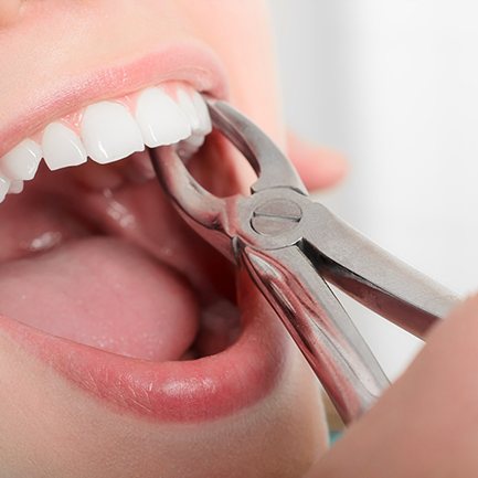 a patient undergoing tooth extractions in Hackettstown