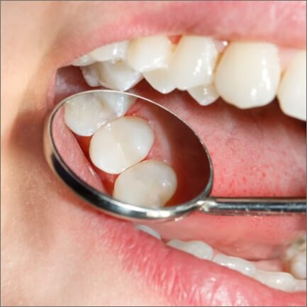 Closeup of smile with composite resin tooth colored fillings