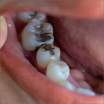 Closeup of back teeth with metal fillings